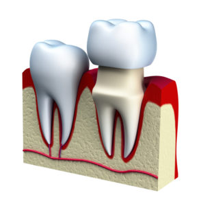 dental-crown