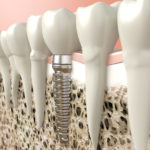 Example of a Dental implant