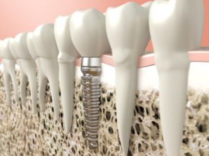 Example of a Dental implant