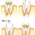 Diagram of Root Canal