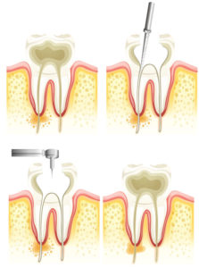 Diagram of Root Canal