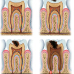 Diagram of Tooth Decay