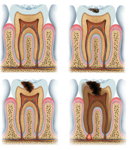 Diagram of Tooth Decay